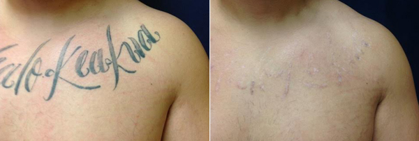 the first photo shows a tattoo with text across someones upper chest, the second is the tattoo removed