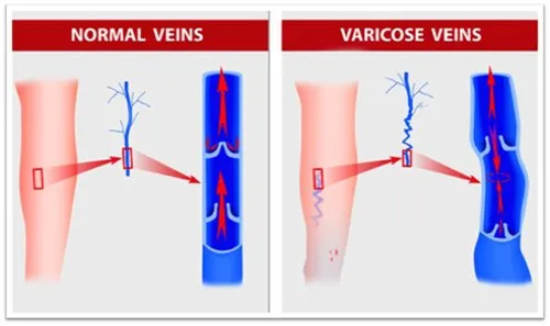 Vericoise Veins