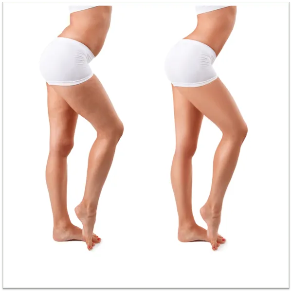 cellulite-removal