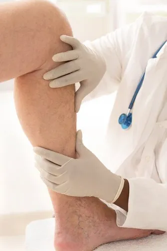 what-causes-varicose-veins