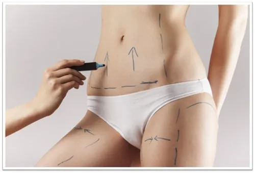 Smart Liposuction