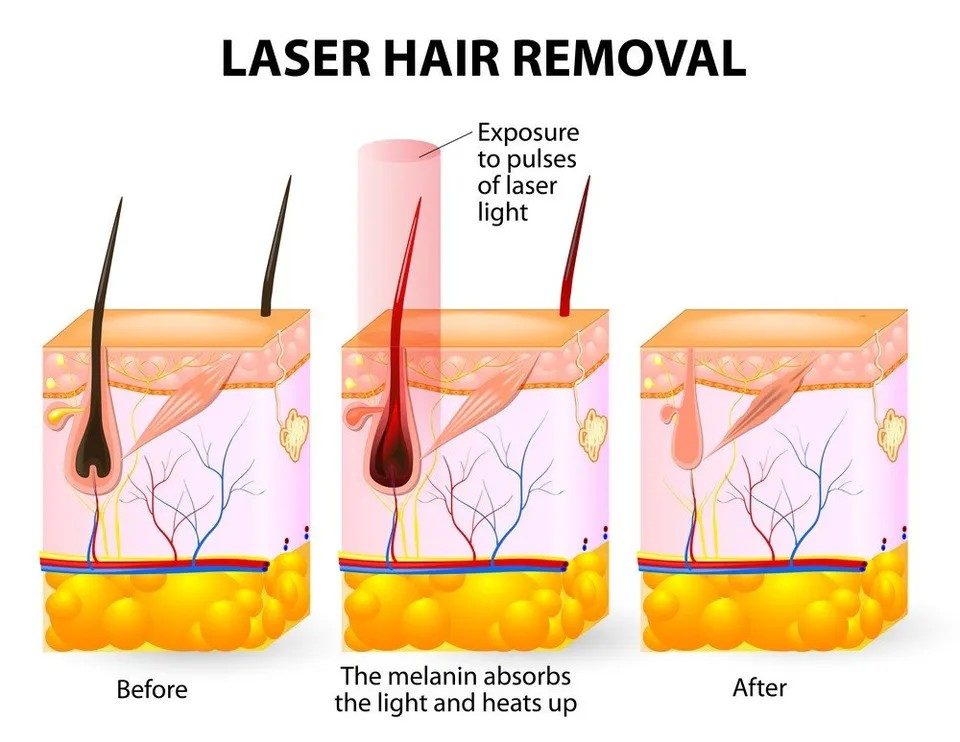 Laser Hair Removal