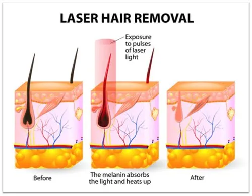 Laser Hair Removal