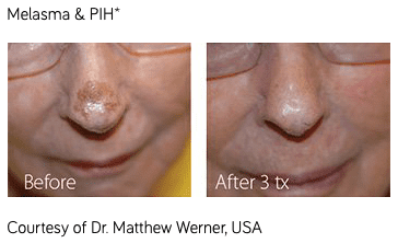 melasma treatment