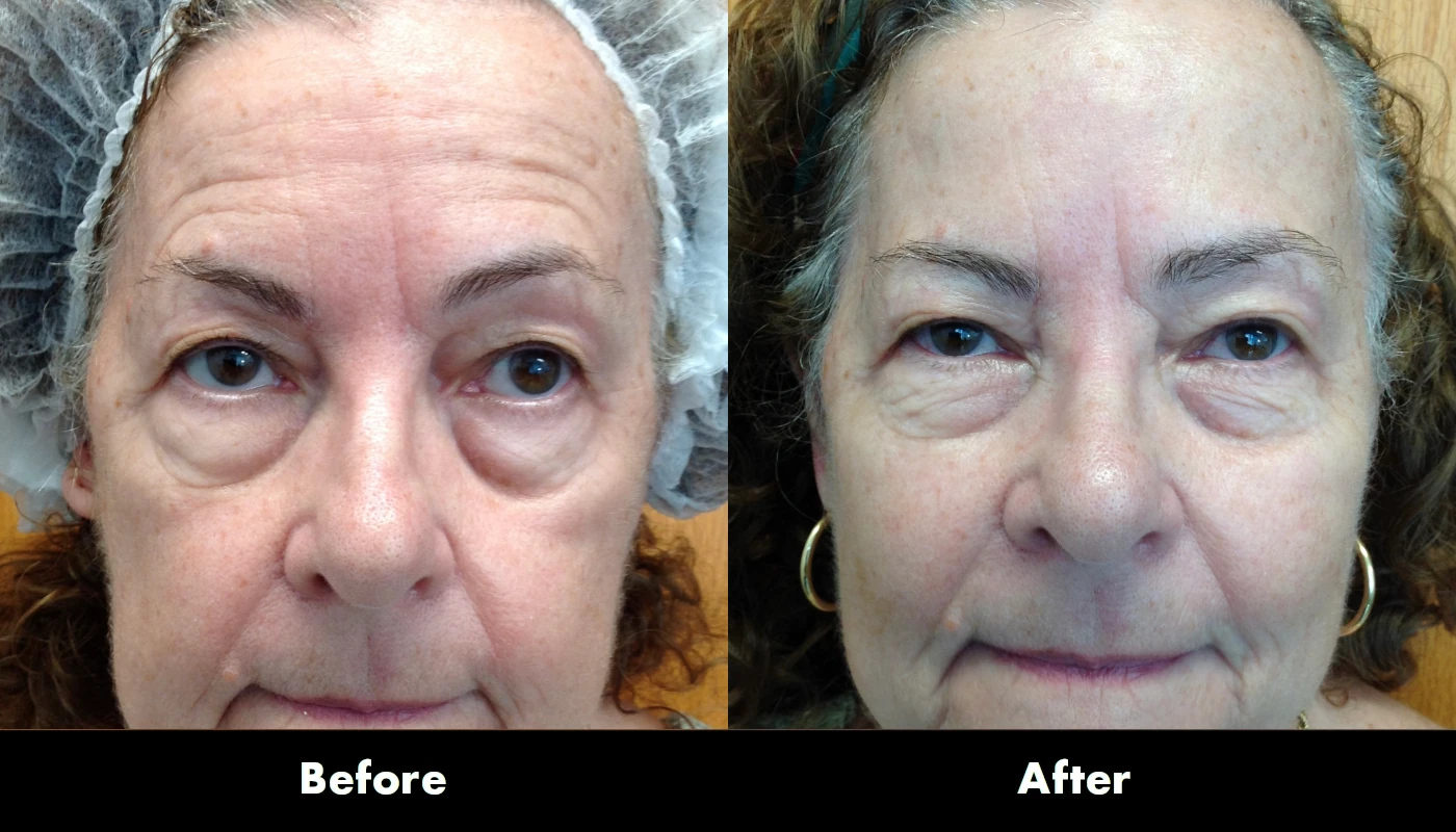 Juvederm 3