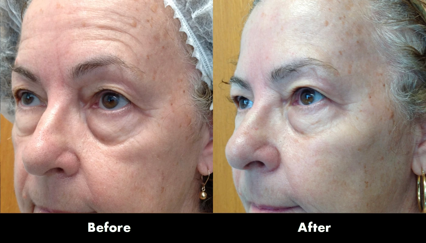 Juvederm 3