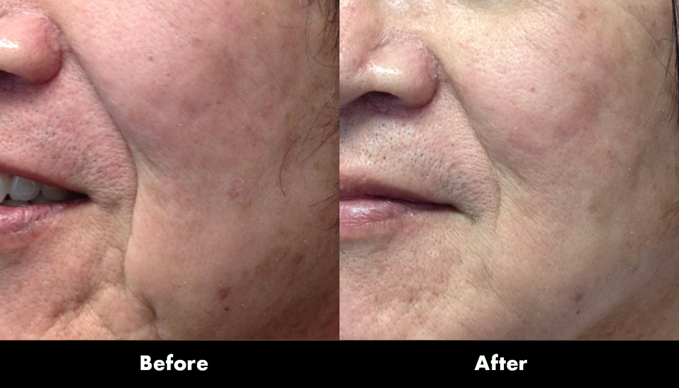 Juvederm 3