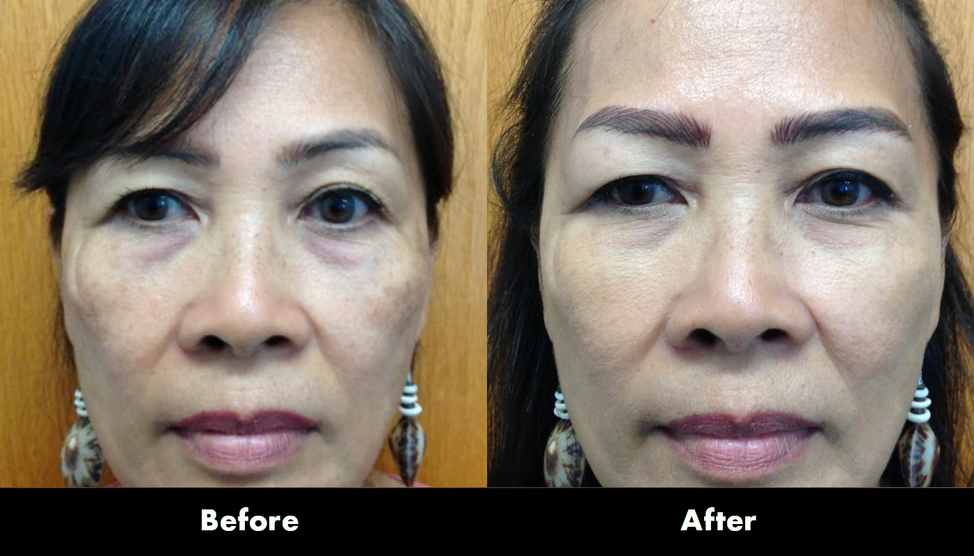 Juvederm 3