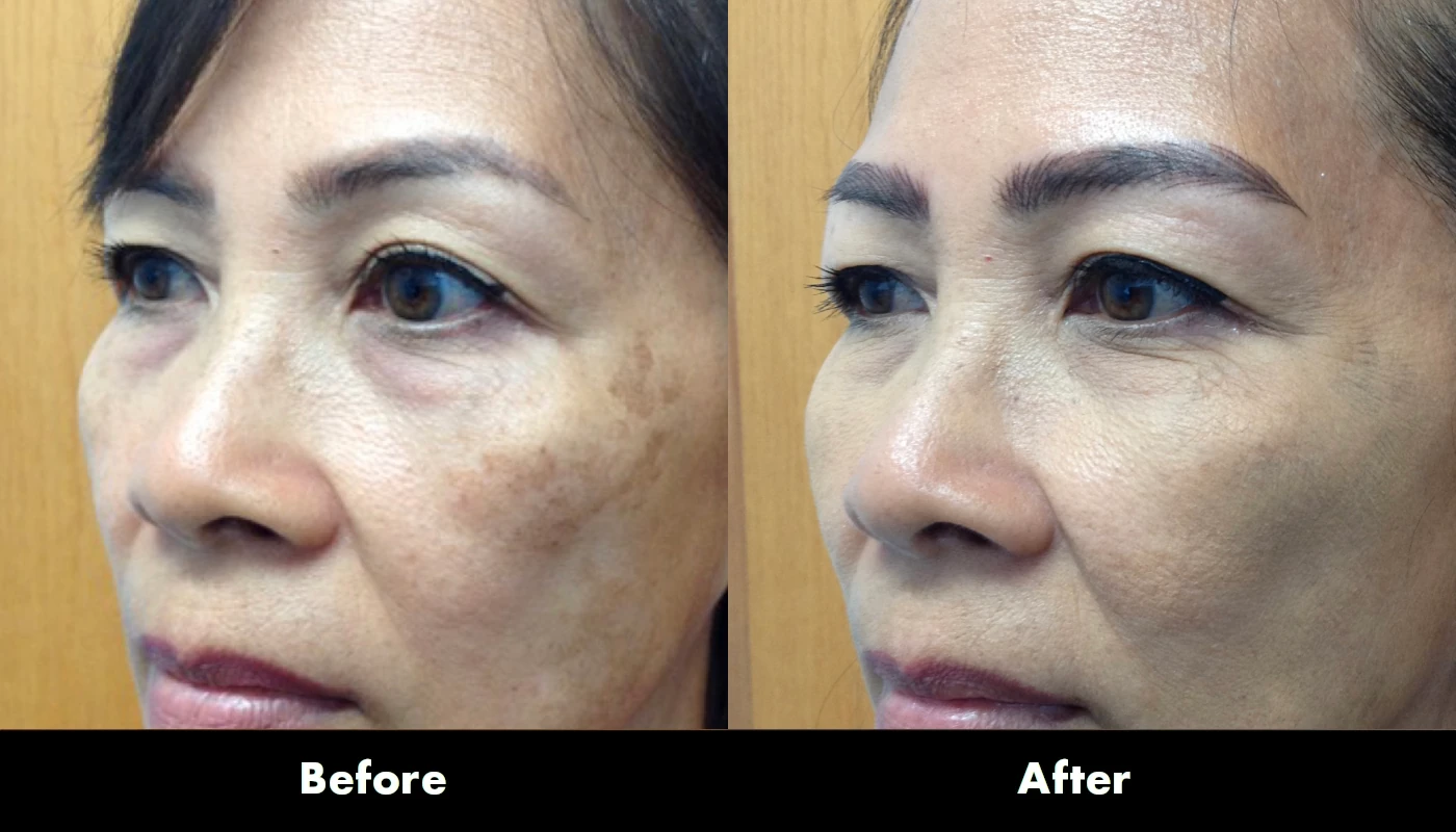 Juvederm 3