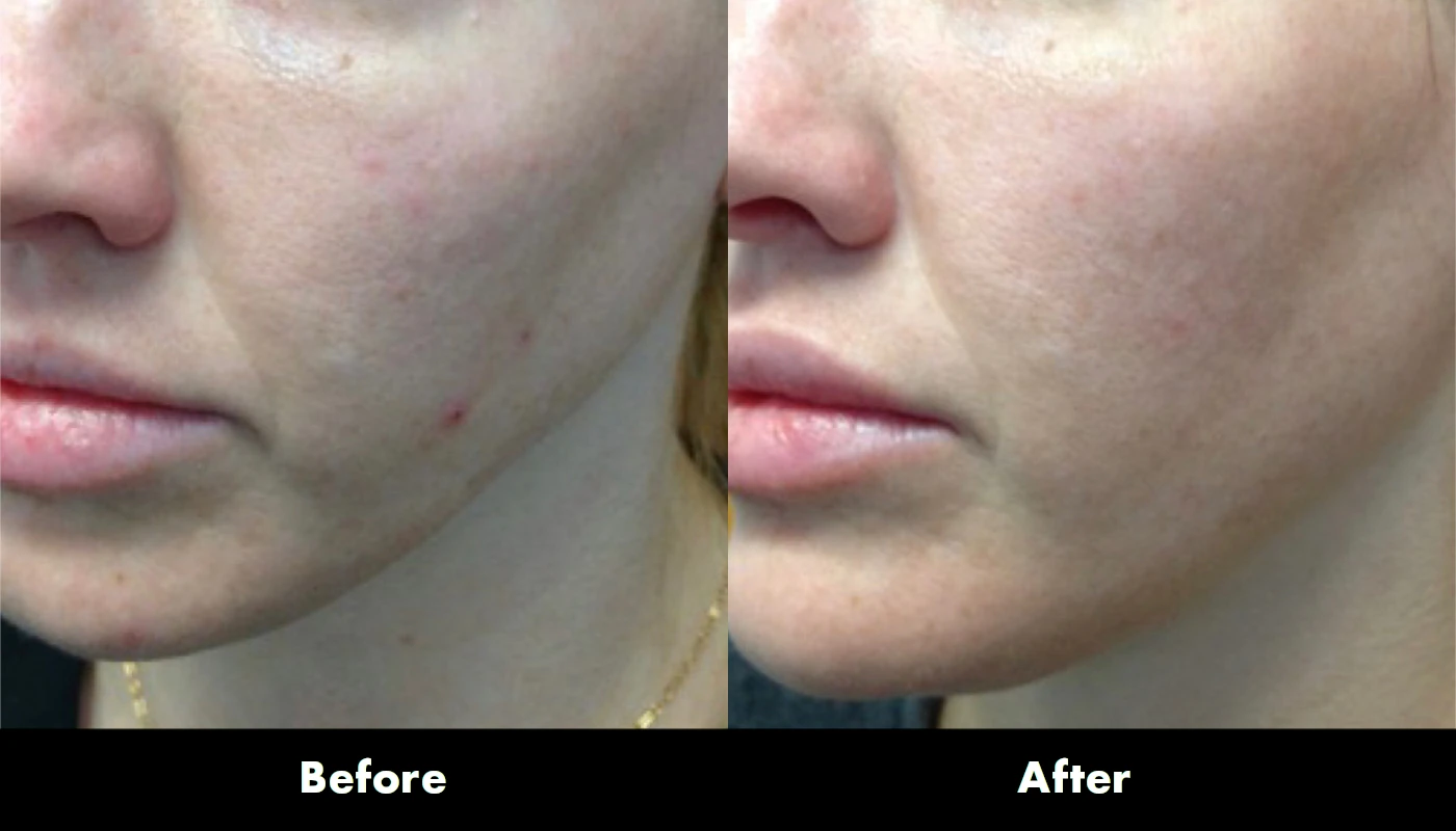 Juvederm 3
