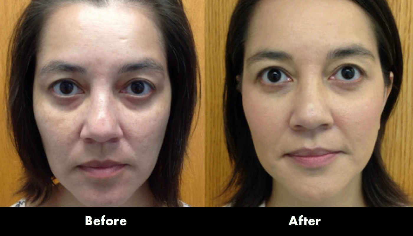 Juvederm 4
