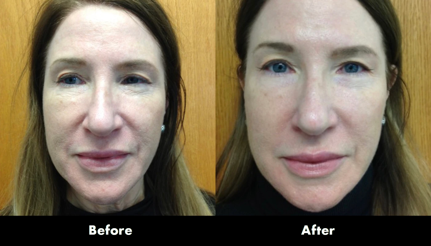Juvederm 5