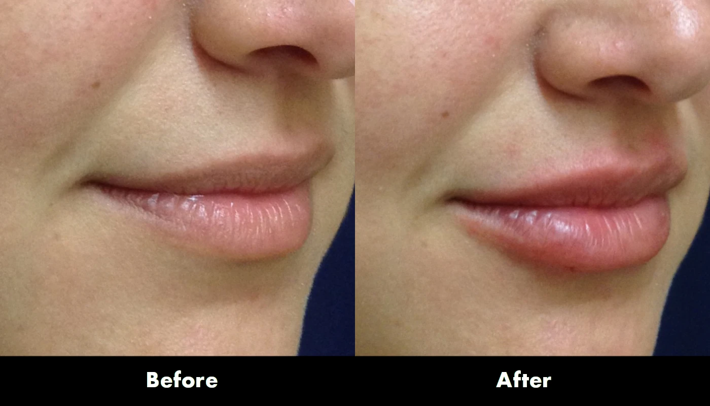 Juvederm 6