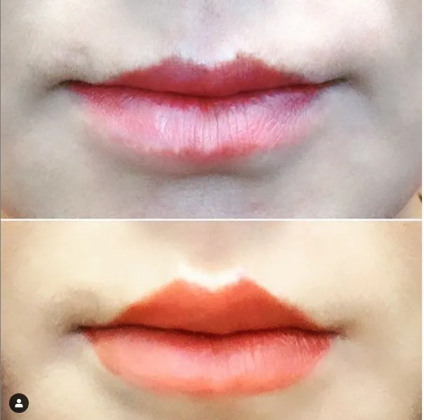 Juvederm 2