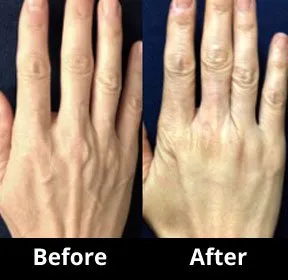 Juvederm 3