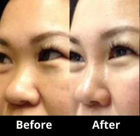Juvederm 4