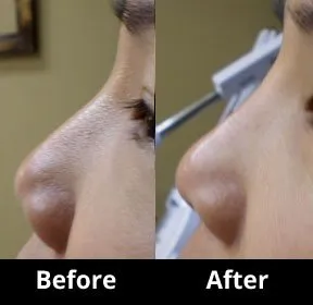 Juvederm 5