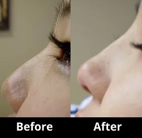 Juvederm 6