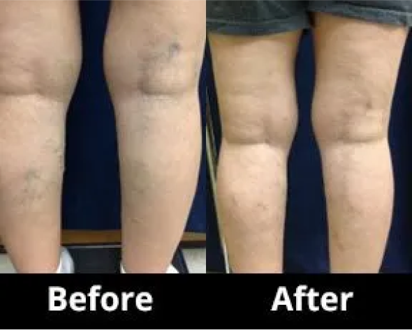 Ultrasound Guided Sclerotherapy