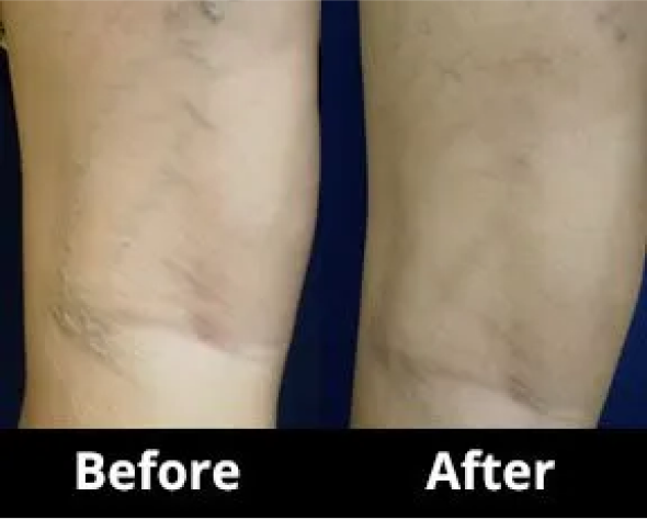 Visual Sclerotherapy