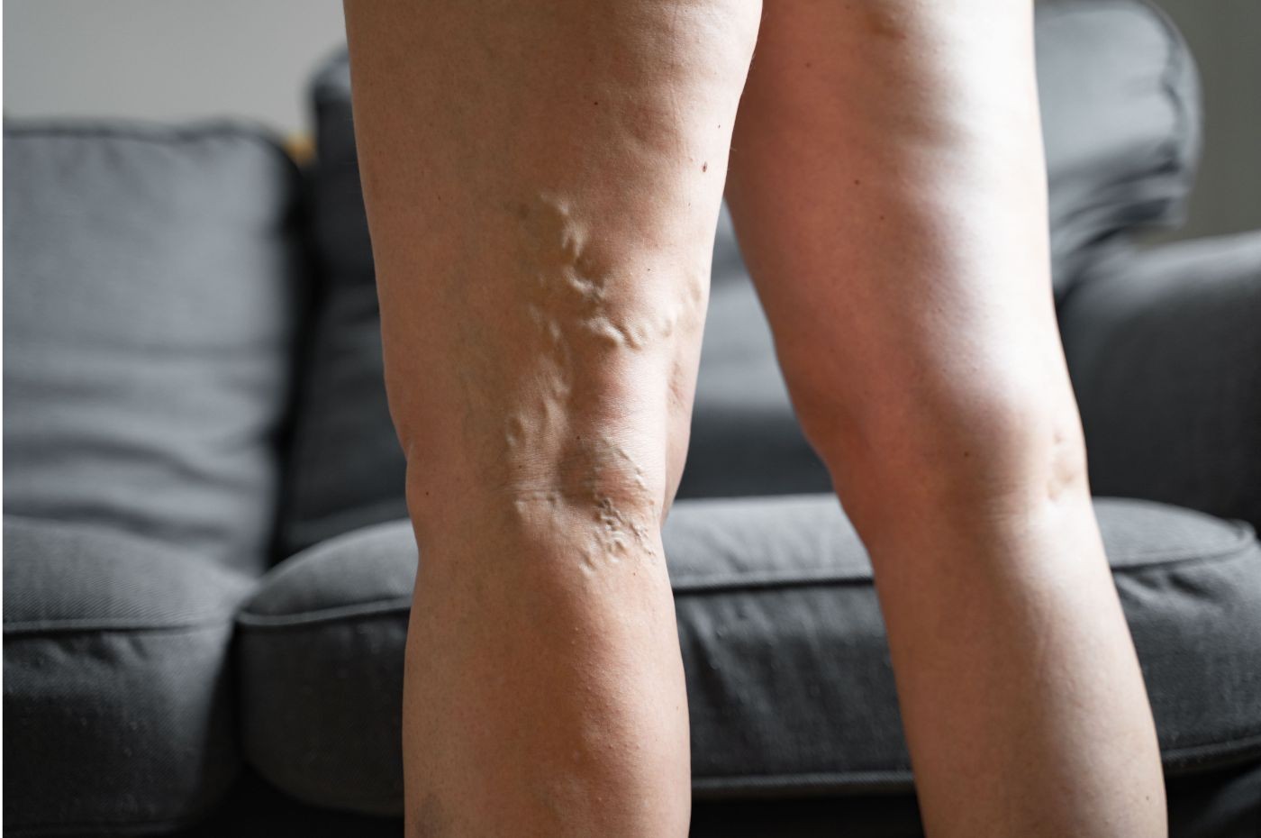 Understanding the Long-term Benefits of Treating Varicose Veins