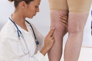 Get Rid of Varicose Veins This Summer