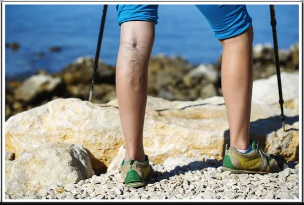 Is Your Work Causing Your Varicose Veins?