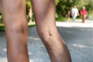 What’s the Difference between Spider Veins & Varicose Veins?