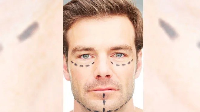 Cosmetic Surgery for Men on the Rise