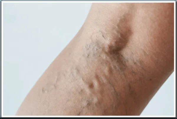 How To Manage and Treat Varicose Veins