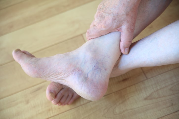 Spider veins on ankle of man
