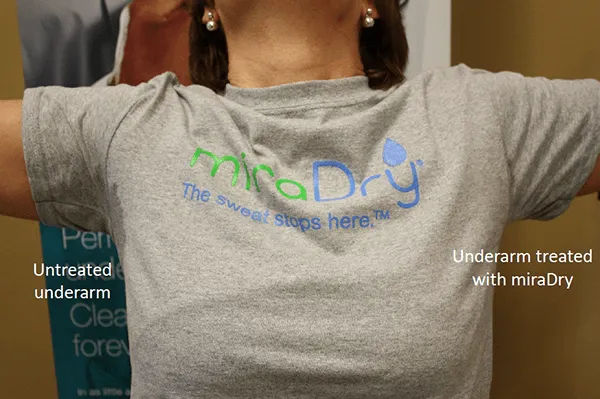 Before and After Image: miraDry - front