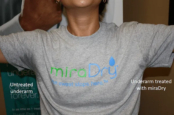 Before and After Image: miraDry - front