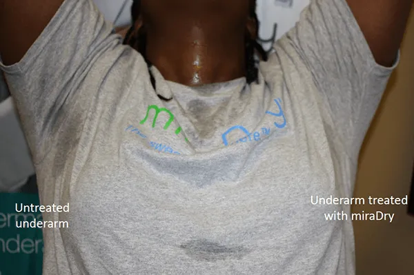 Before and After Image: miraDry - front