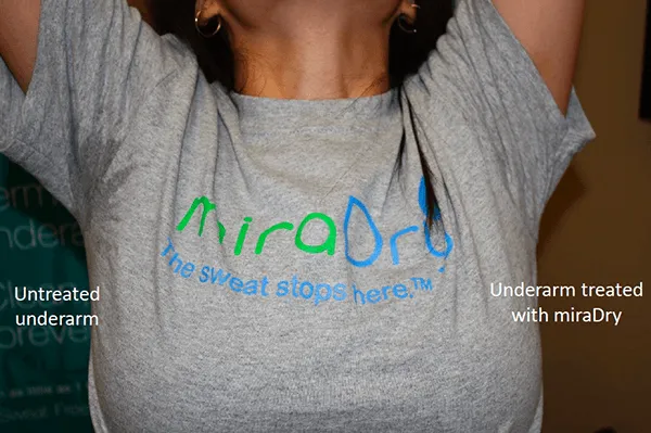 Before and After Image: miraDry - front