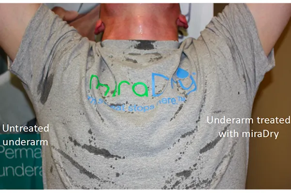 Before and After Image: miraDry - front