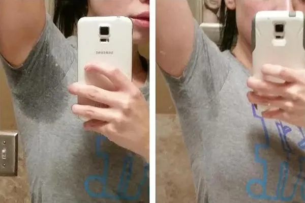 Before and After Image: miraDry - front