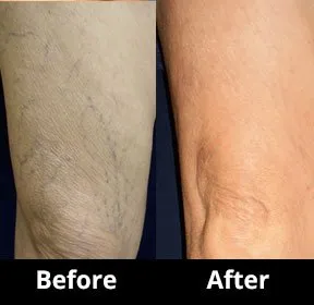 Before and After Image: Veins - back