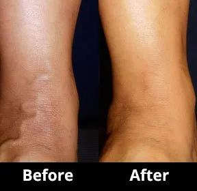 Before and After Image: Veins - back