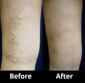 Before and After Image: Veins - back