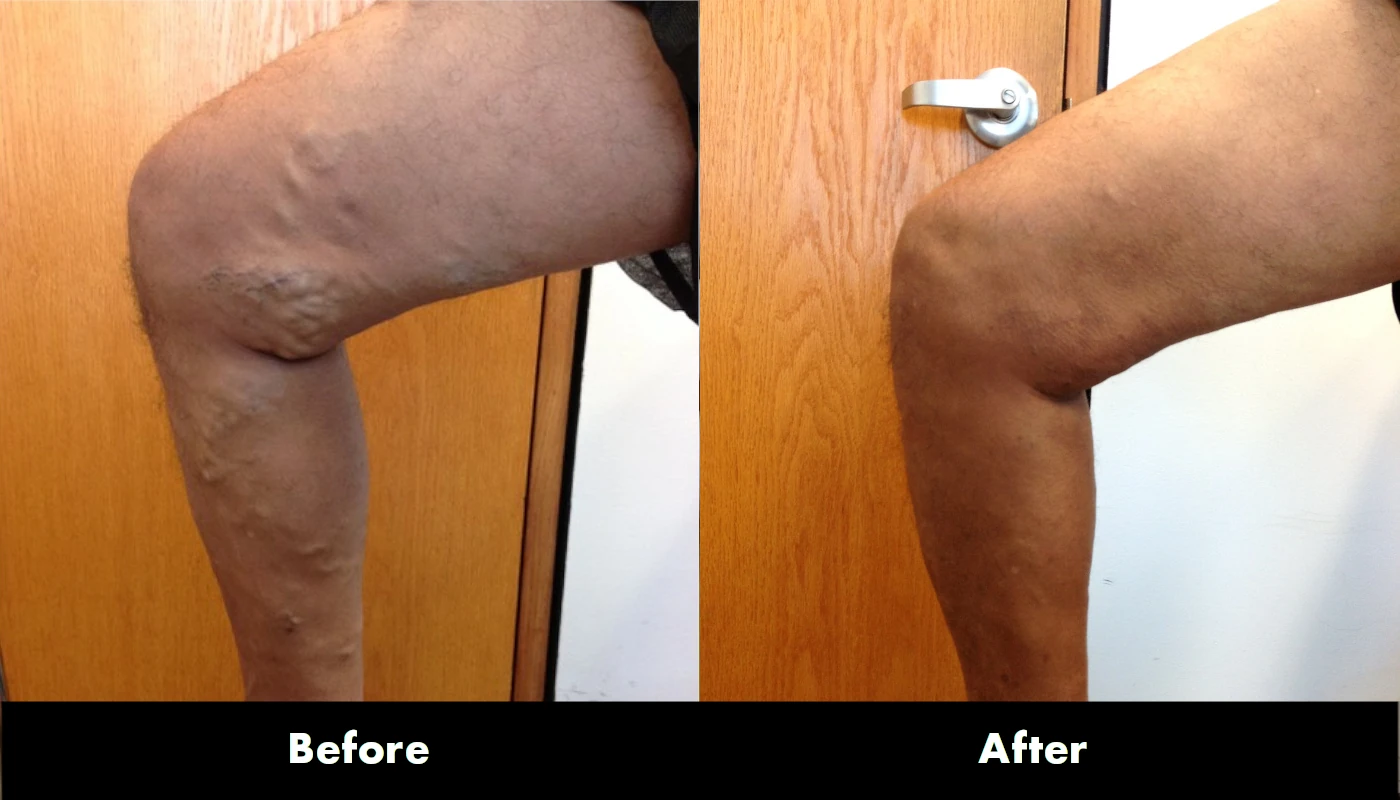 Before and After Image: Veins - left-side