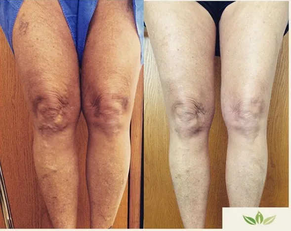 Before and After Image: Veins - front