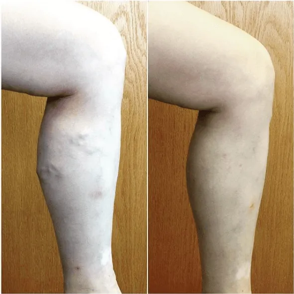 Before and After Image: Veins - right-side