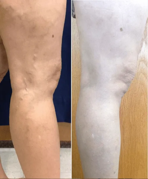 Before and After Image: Veins - right-side
