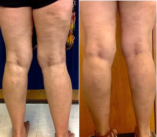 Before and After Image: Veins - back