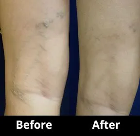 Before and After Image: Veins - back