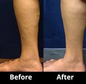 Before and After Image: Veins - left-side