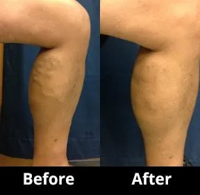 Before and After Image: Veins - right-side
