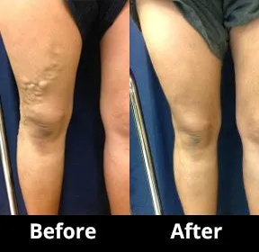 Before and After Image: Veins - front