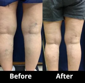 Before and After Image: Veins - back